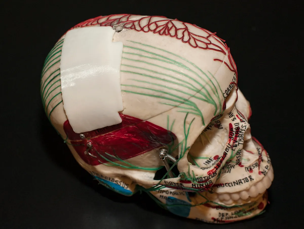Modelo de cranio com uma placa branca impressa em 3D fixada na lateral, usada em reconstrucao de face